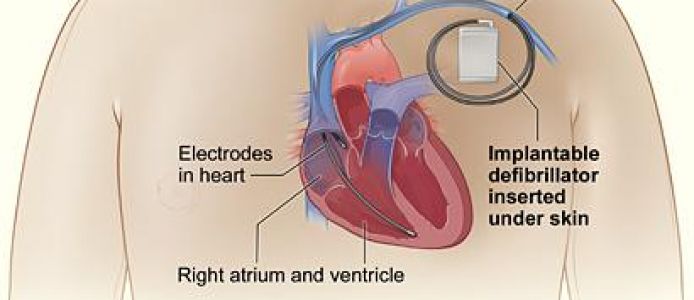Cardioverter Defibrillator Devices Market Blog