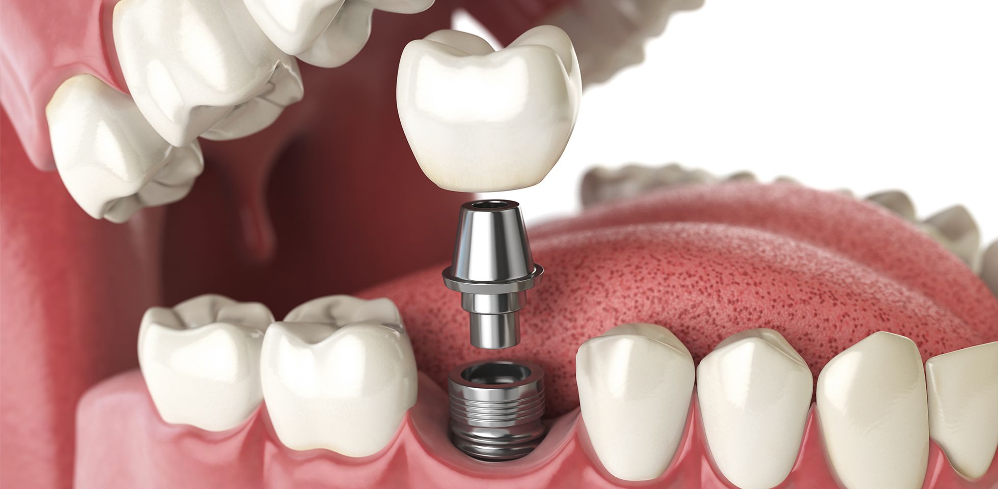 best dental implants