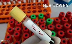 Rising Organ Failure Rates and Advances in HLA Techniques Drive the Growth of the HLA Typing Market