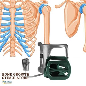 Bone Growth Stimulators Market