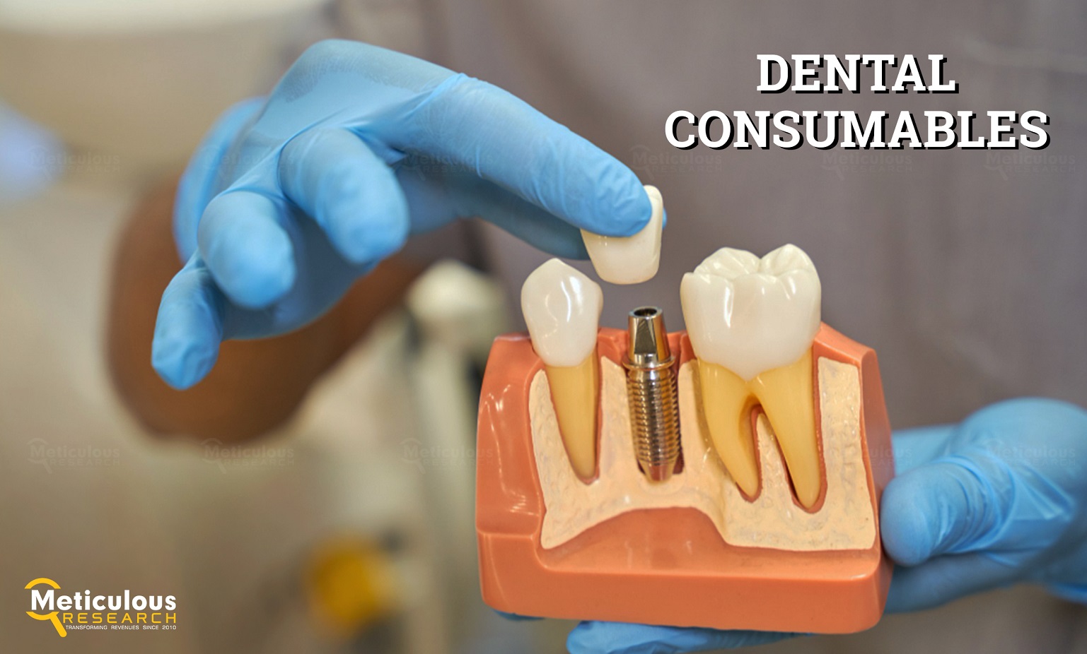 Dental Consumables Market